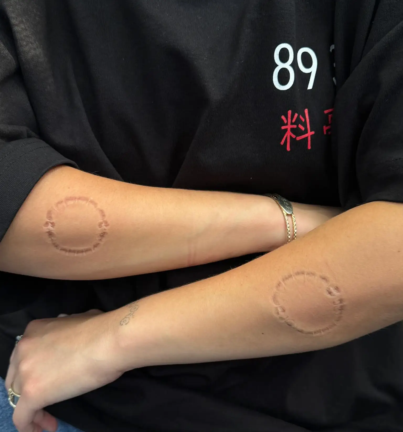 The bite marks on the singers forearms raised concerns for fans. (Instagram/billieeilish)