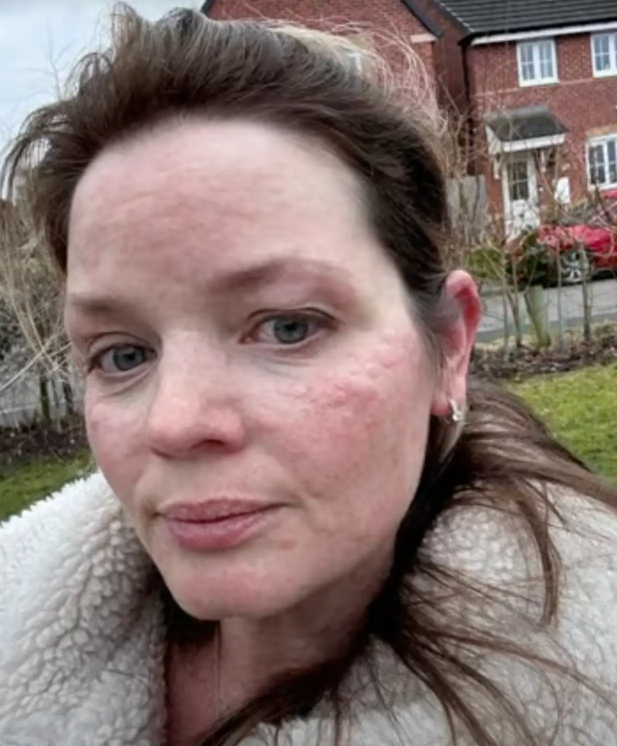 Kirsten Evans' cold-induced urticaria essentially renders her 'allergic to winter' (ITV)