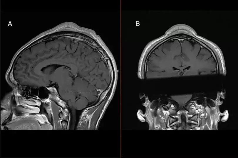 It turned out to have been caused by his breakdancing (BMJ Case Reports)