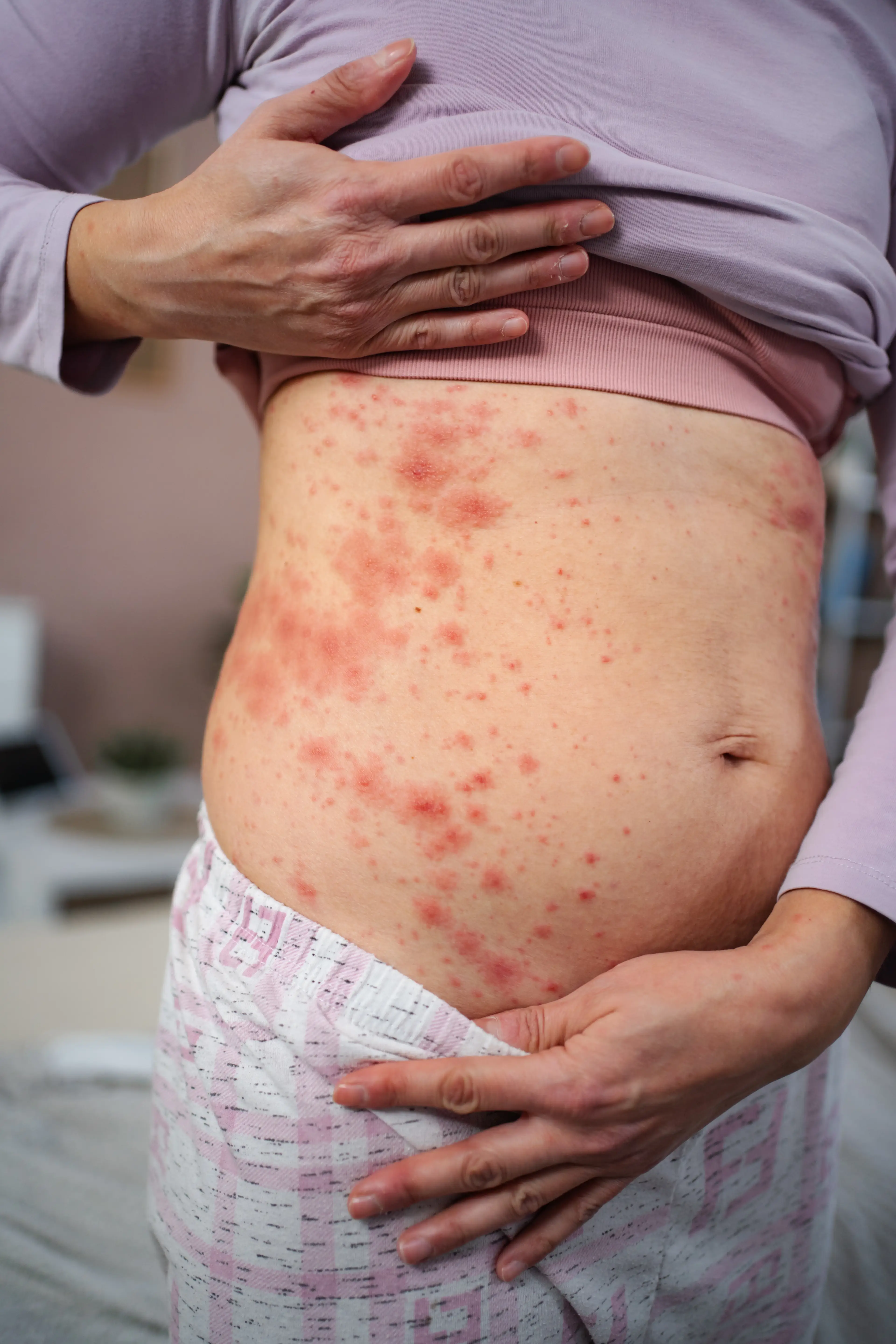 Measles cases are rising in the US (VIJ/Getty)