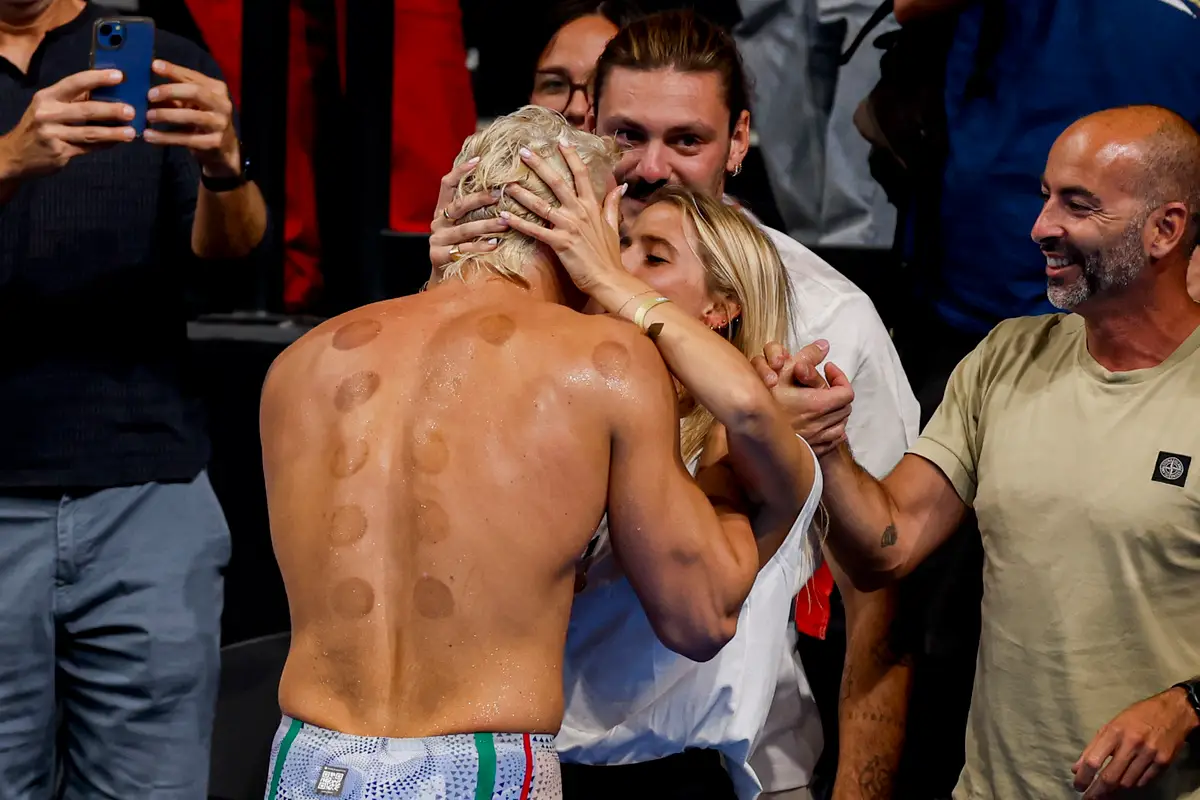 Experts are still unsure of the full benefits of cupping therapy. (Marcel ter Bals/DeFodi Images/DeFodi via Getty Images)