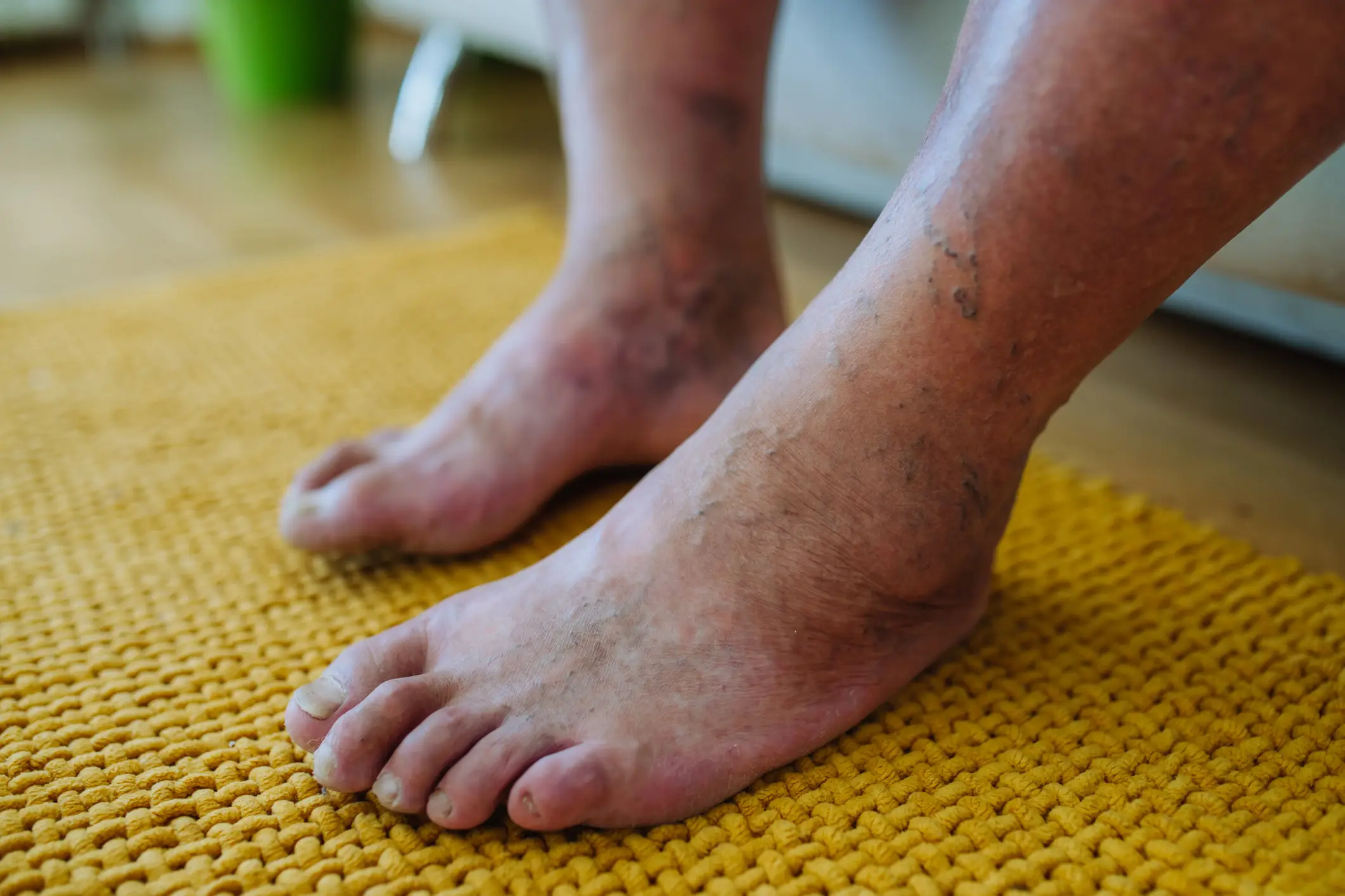 The woman's feet became discolored and cold to touch (Getty stock)