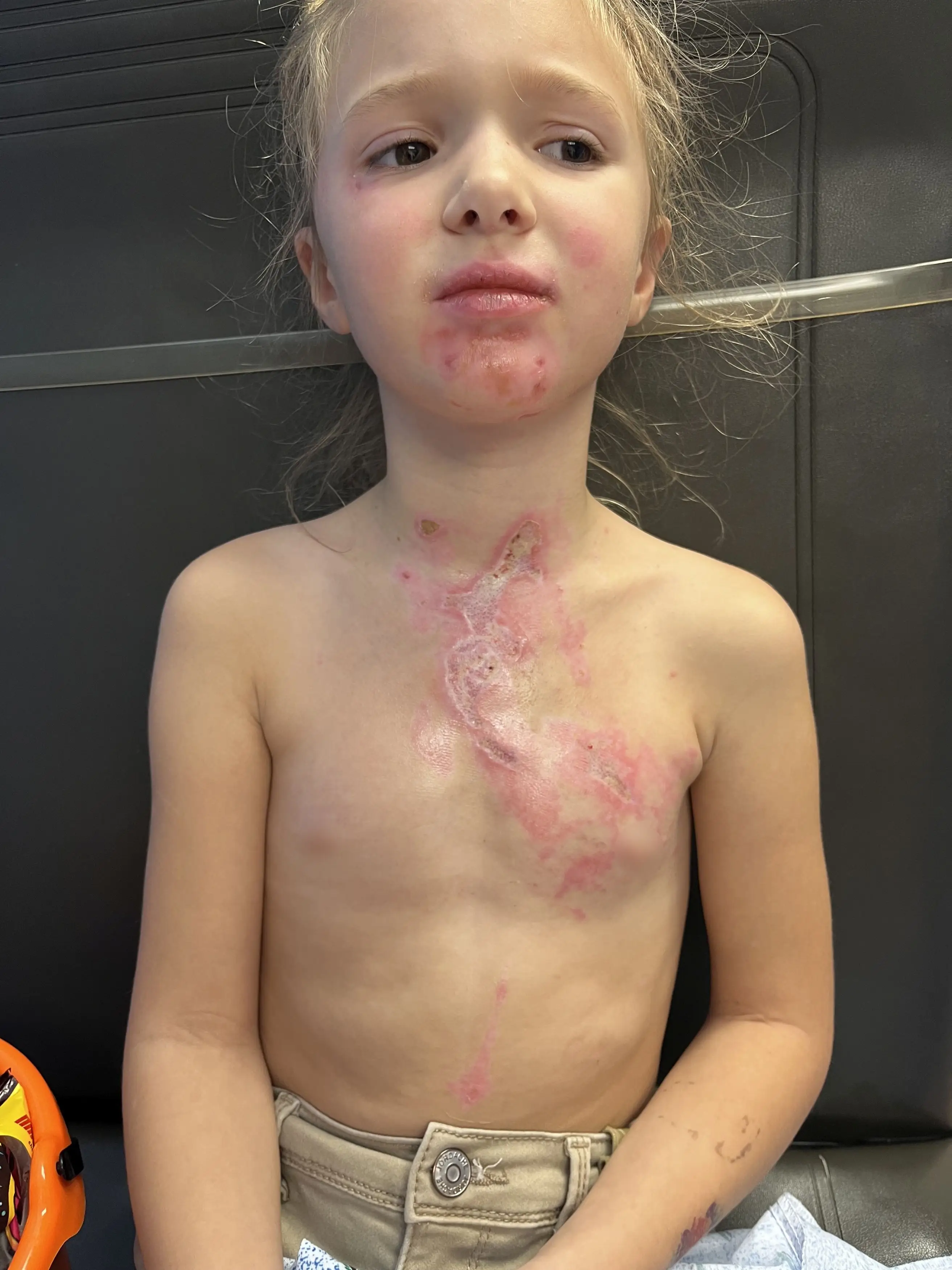 7-year-old Scarlett was left with severe scars from the incident (Kennedy News)