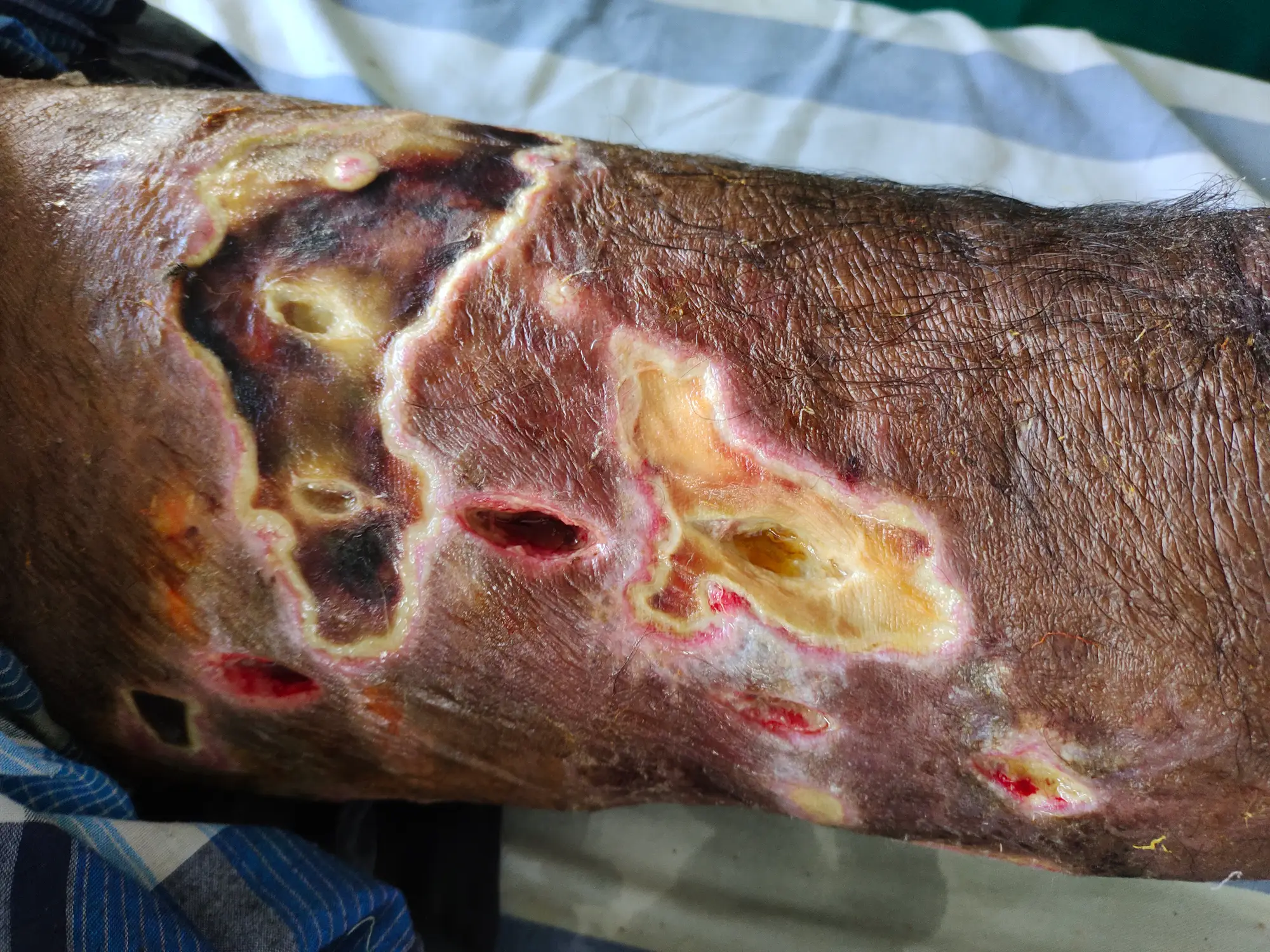 Health officials say anyone with an open wound exposed to salt or brackish water should monitor it closely for signs of infection. (Getty stock image)