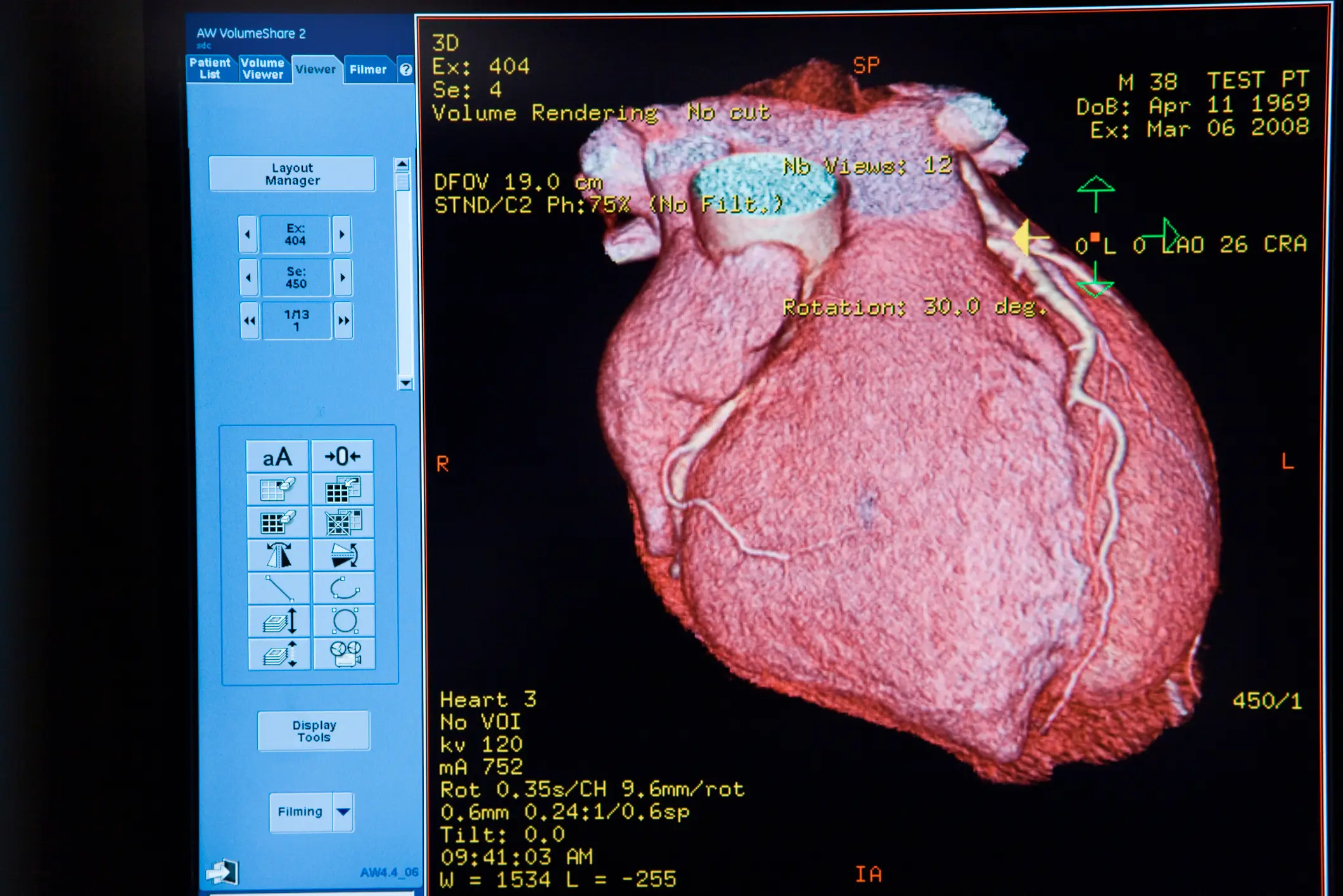 Congenital heart diseases like ASD affect almost 1 in 100 babies born in the UK (Getty Stock Image)