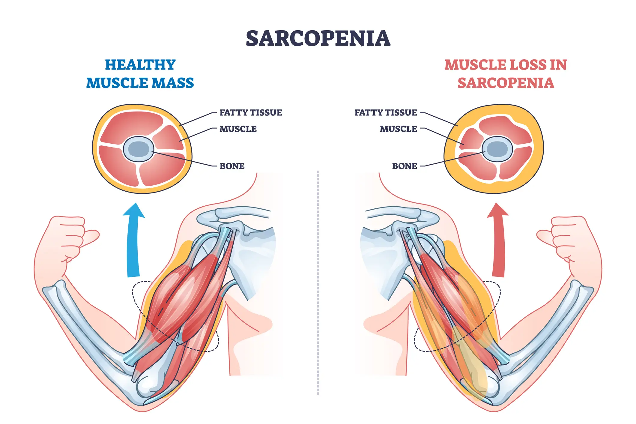 The researchers revealed older people are more likely to have sarcopenia (Getty Stock Images)