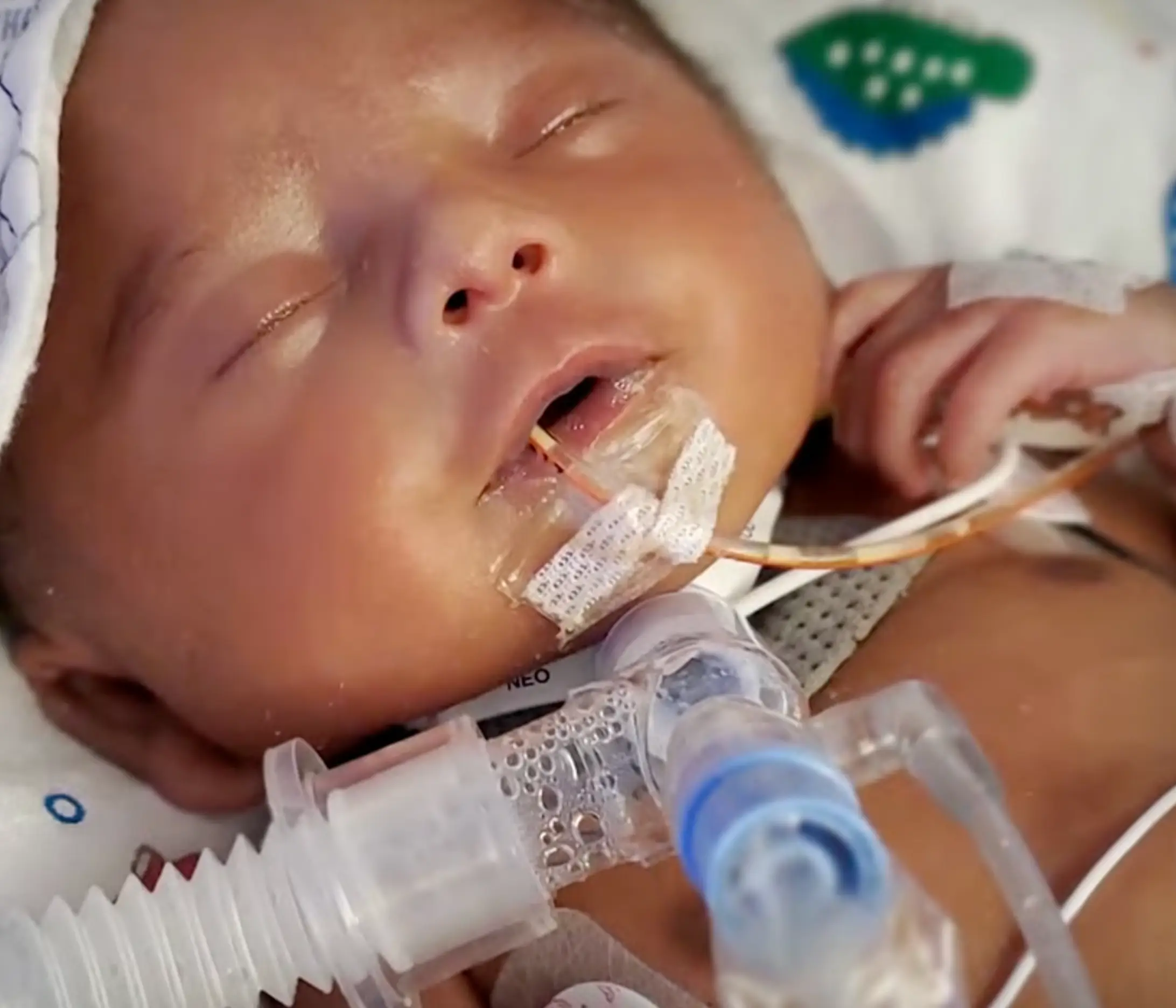 Cassian had a tube inserted into his throat to get around the airway obstruction (ABC/YouTube)