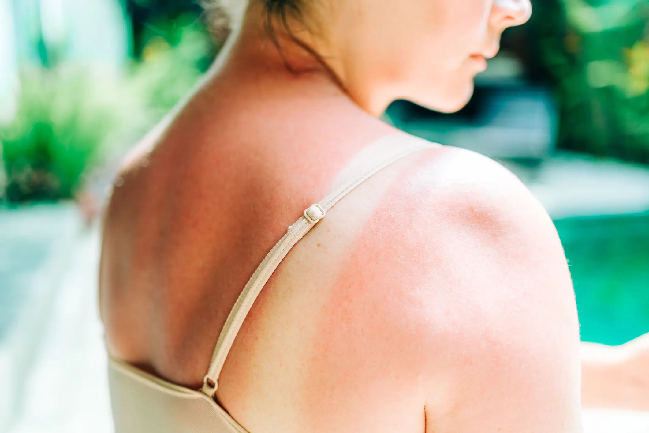 As heatwaves continue to grip the globe, experts have warned of the lasting risks associated with sunburn (Olga Pankova / Getty images)