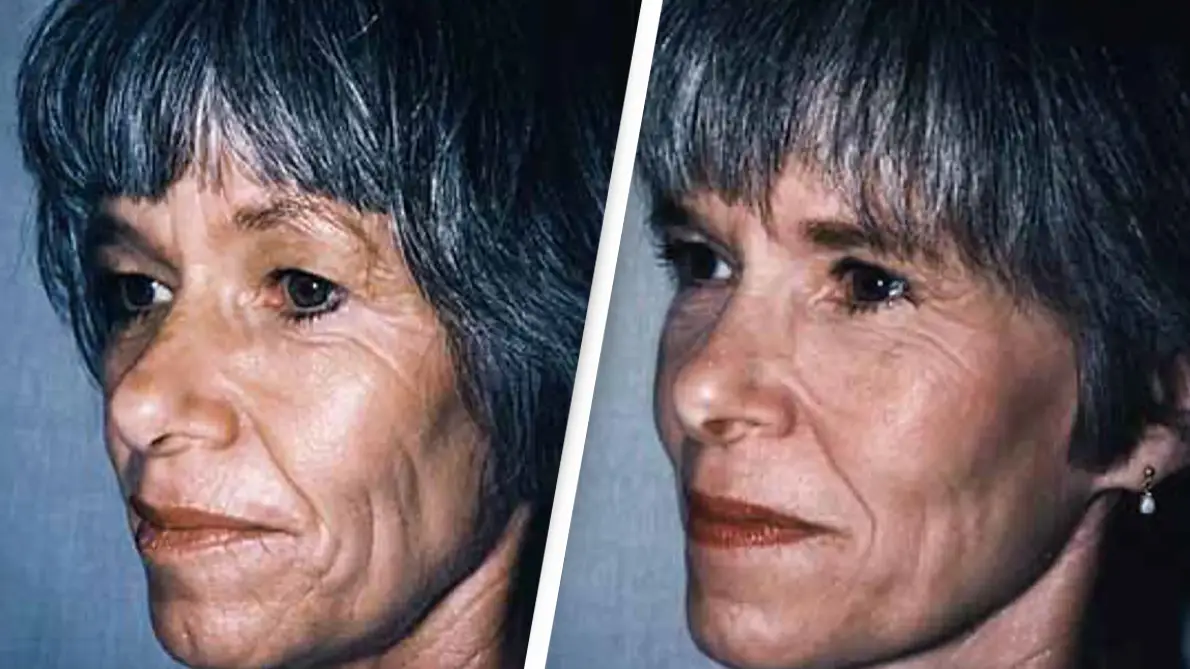 Identical twins show astonishing differences after one had a lot more sun exposure over their lifetime