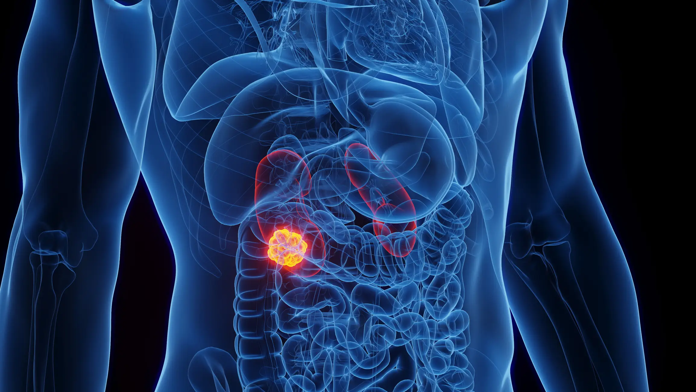 Kidney cancer is among the 10 most common forms of the disease (Sebastian Kaulitzki/Science Photo Library/Getty Images)