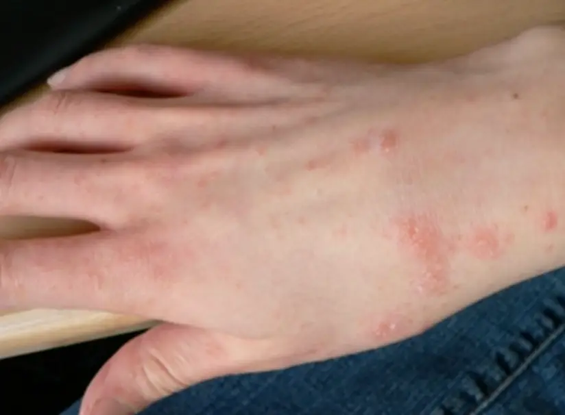 Scabies has become more common in the UK in recent times (YouTube/Med Today)