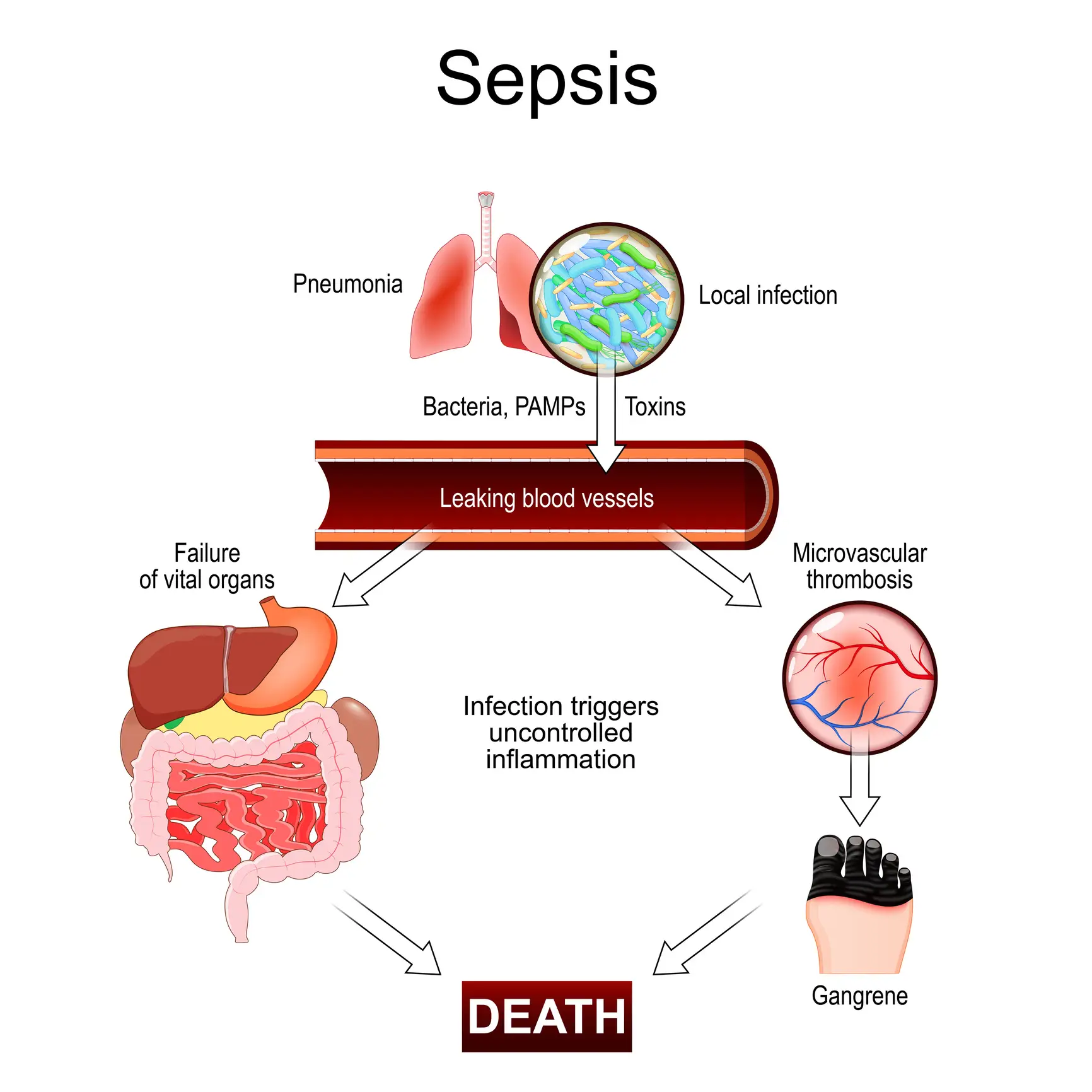 Sepsis is a silent killer that many don't recognize (Getty Stock Images)