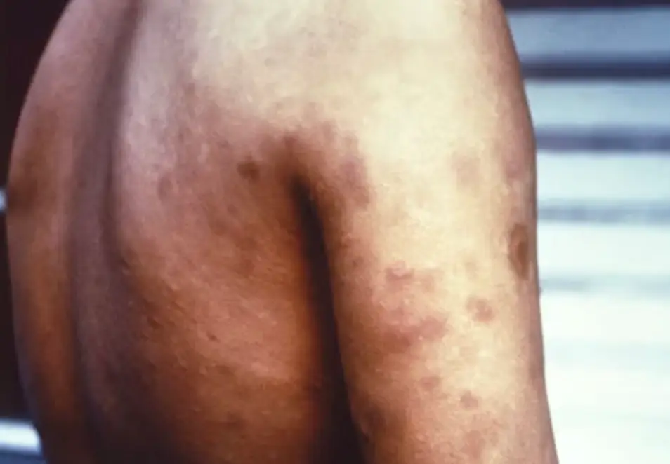 Cases have soared in the state this year. (CDC)