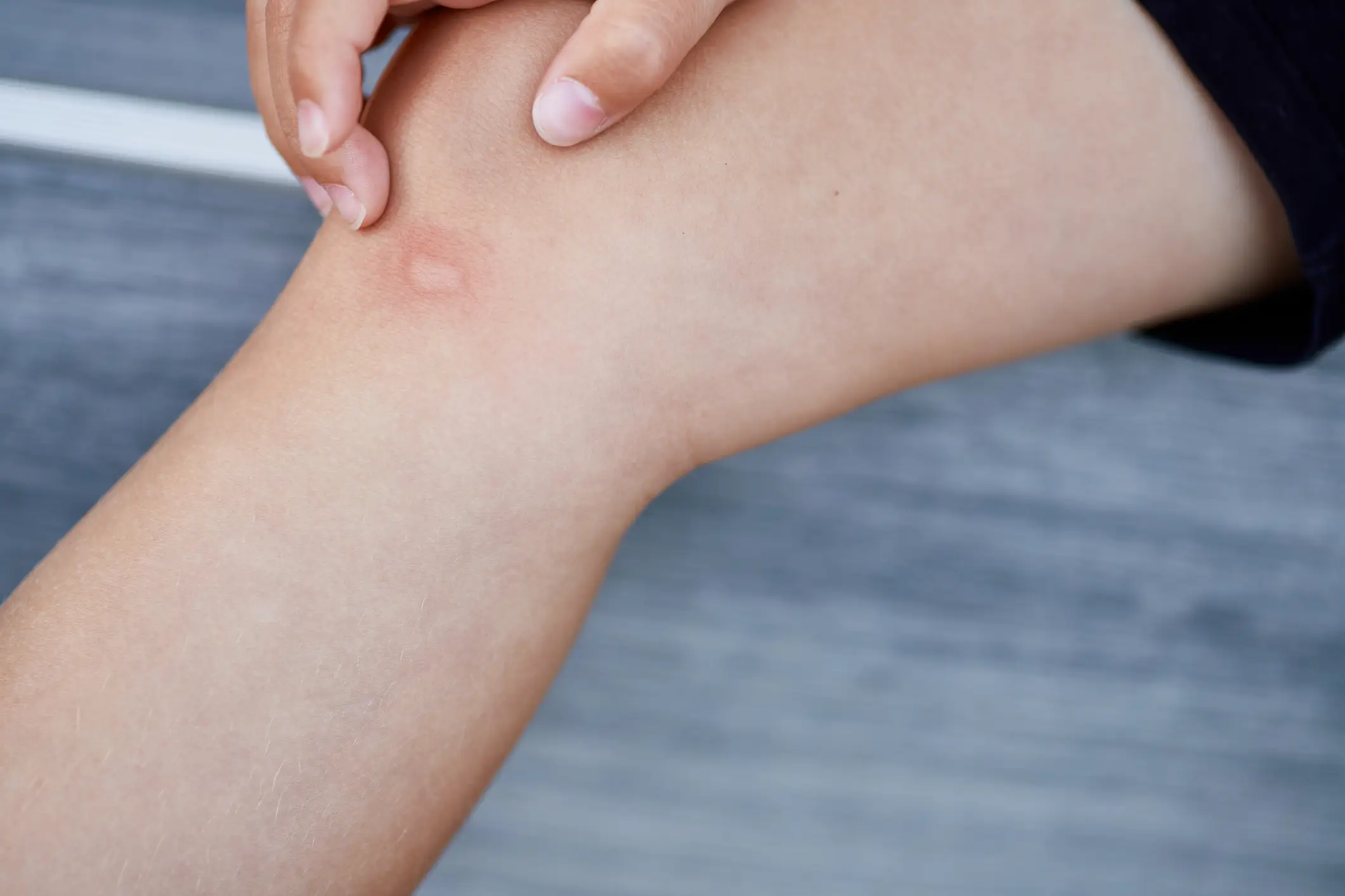 Doctors thought it was a mosquito bite (Getty Stock Image)