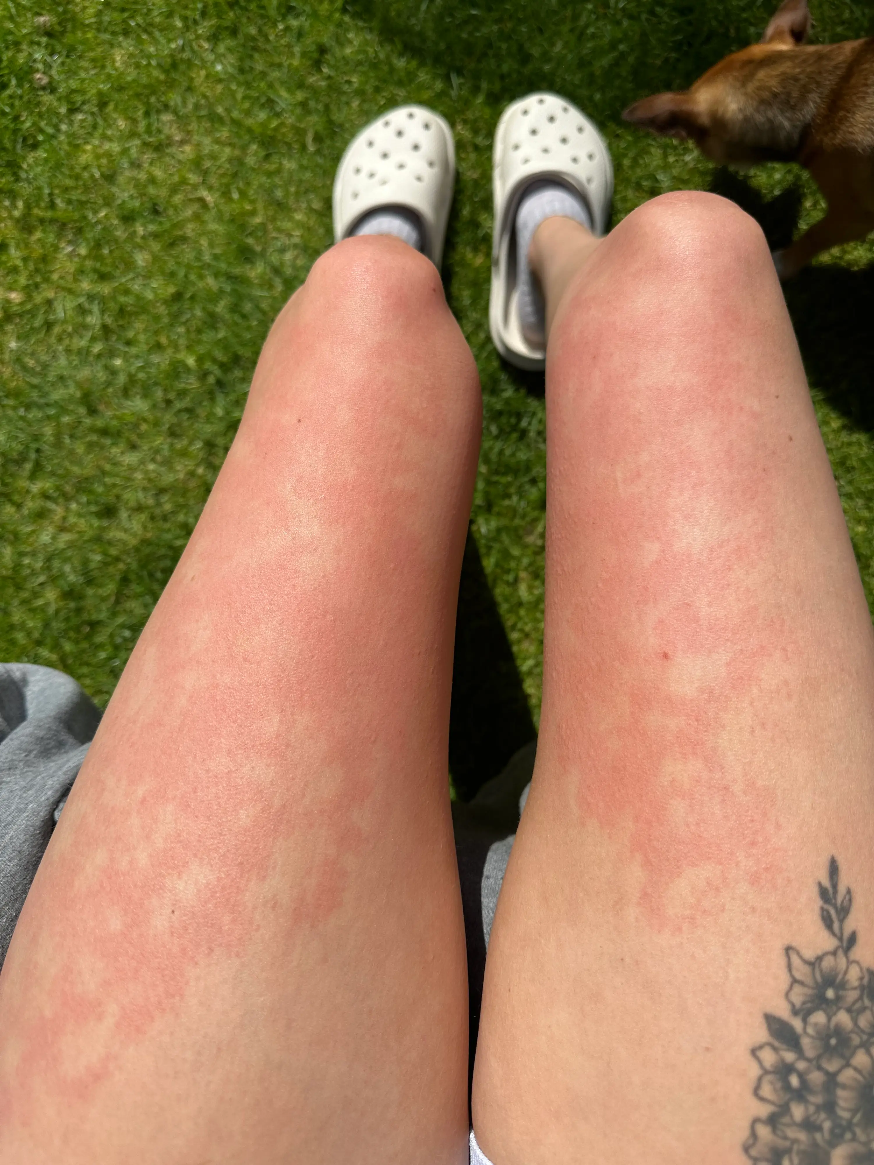 Bathing and rain water causes her skin to break out (Lee McLean/SWNS)