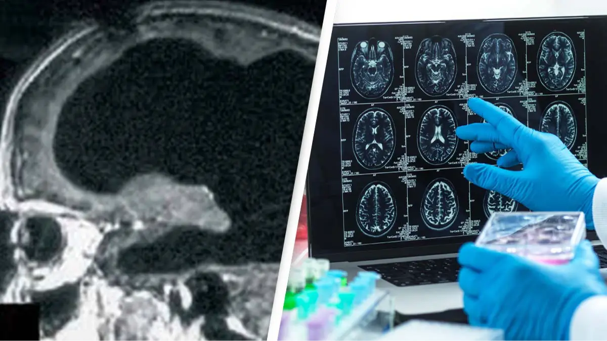 Man was found to be missing 90% of his brain but was still living a normal life
