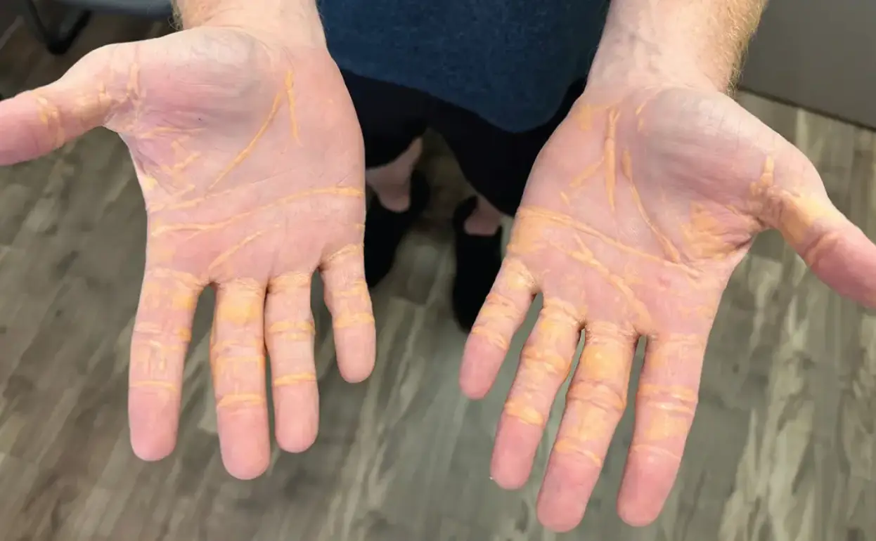 The impact of the man's diet (JAMA Cardiologym 2024, Marmagkiolis et al)