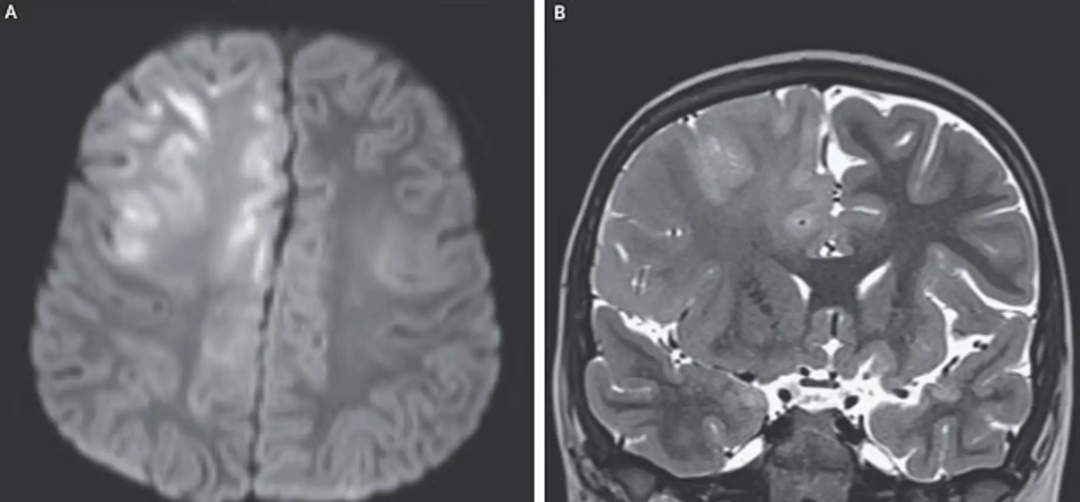 The brain disorder came about as a result of the measles infection (New England Journal of Medicine)