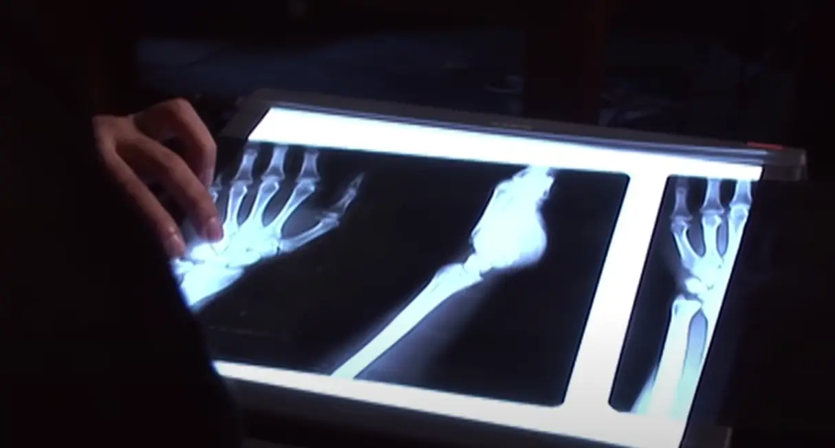 The bone structures of the affected children were also analysed by scientists.