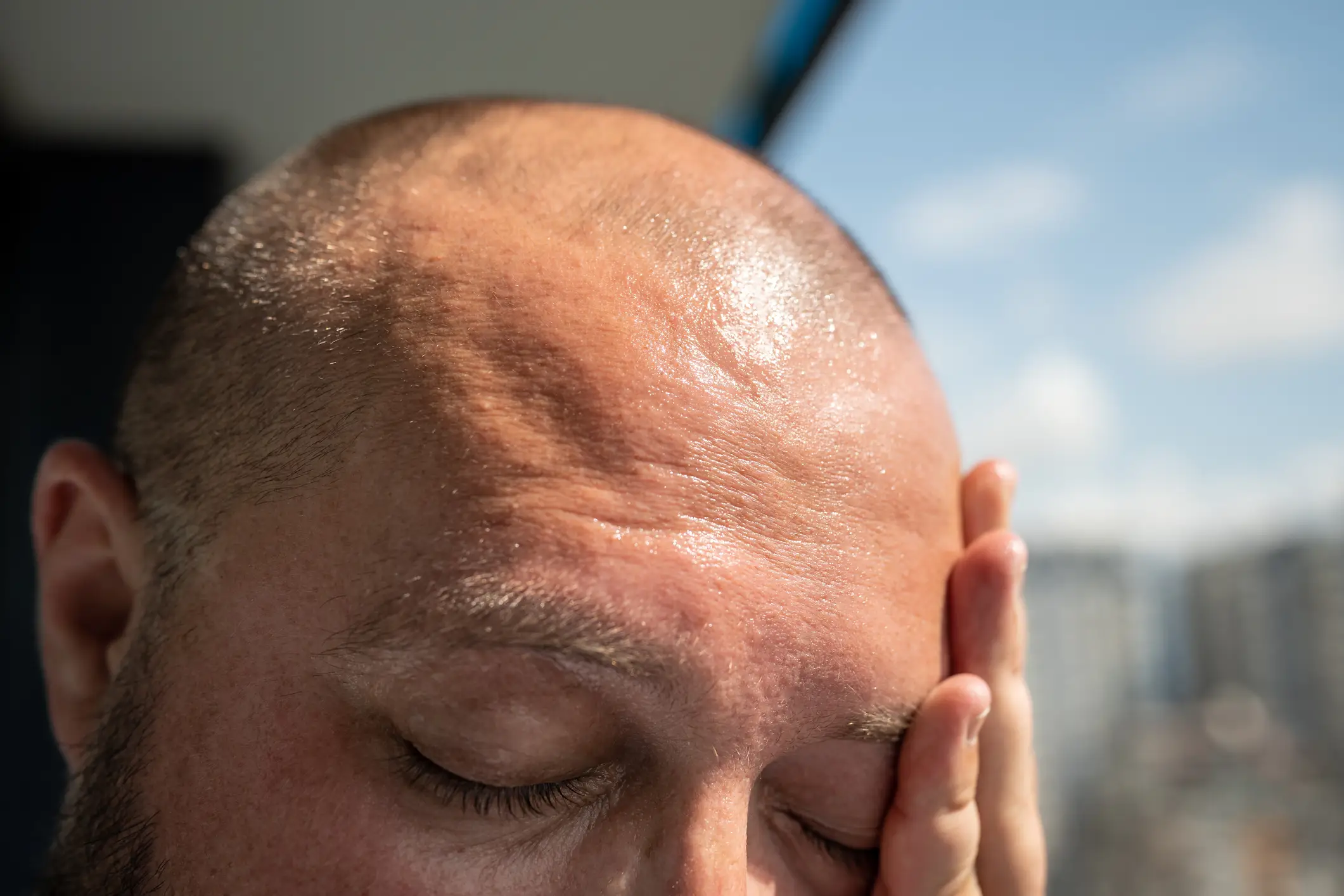 Getting the sun on your head increases your risk of certain conditions if you're not careful (Getty Stock)