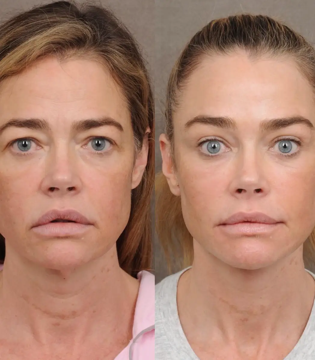 Richards said she thought the idea of a facelift was 'terrifying' (Instagram/@drbentalei)