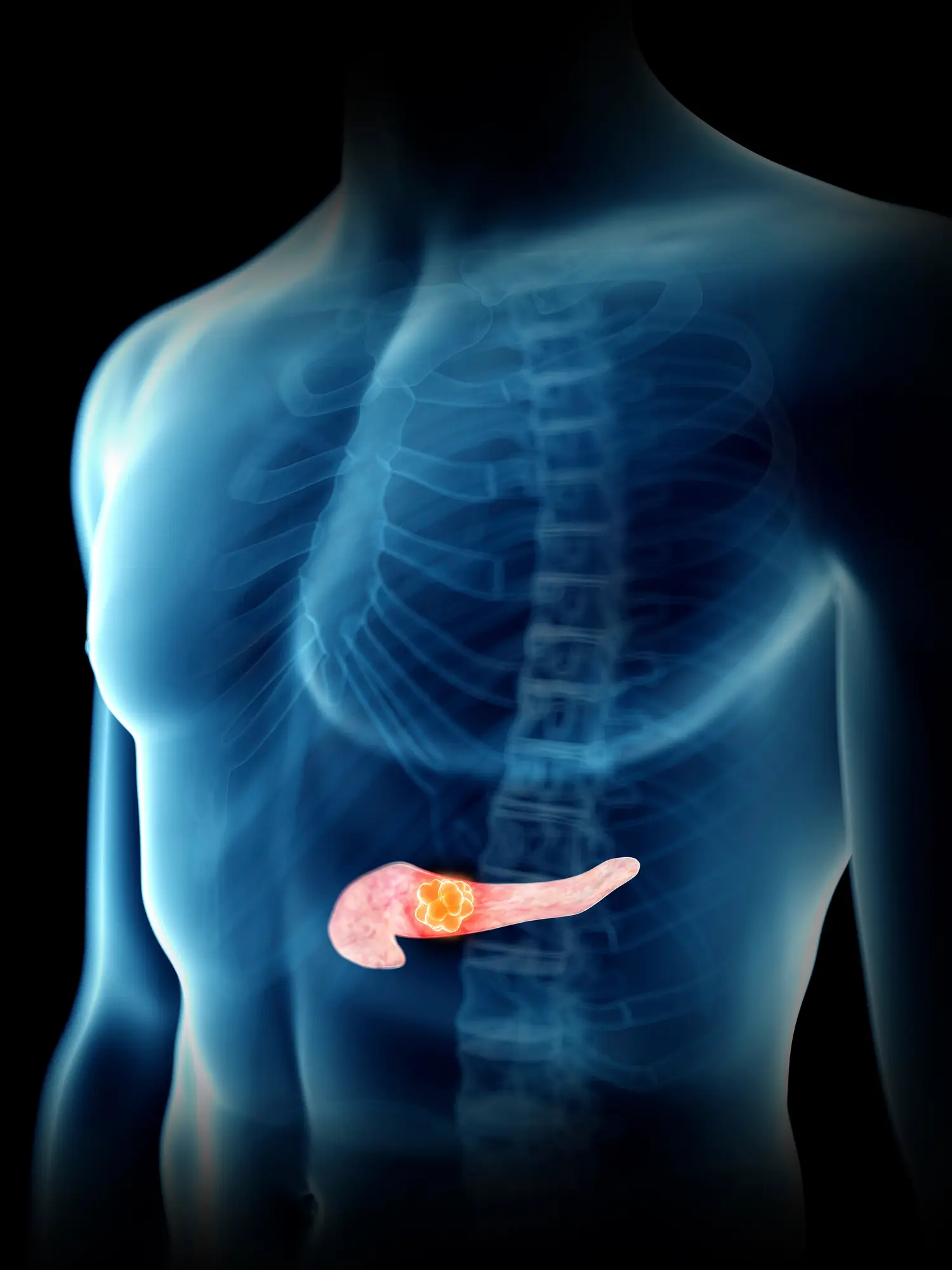 Illustration of a man's pancreas tumour (Getty stock)