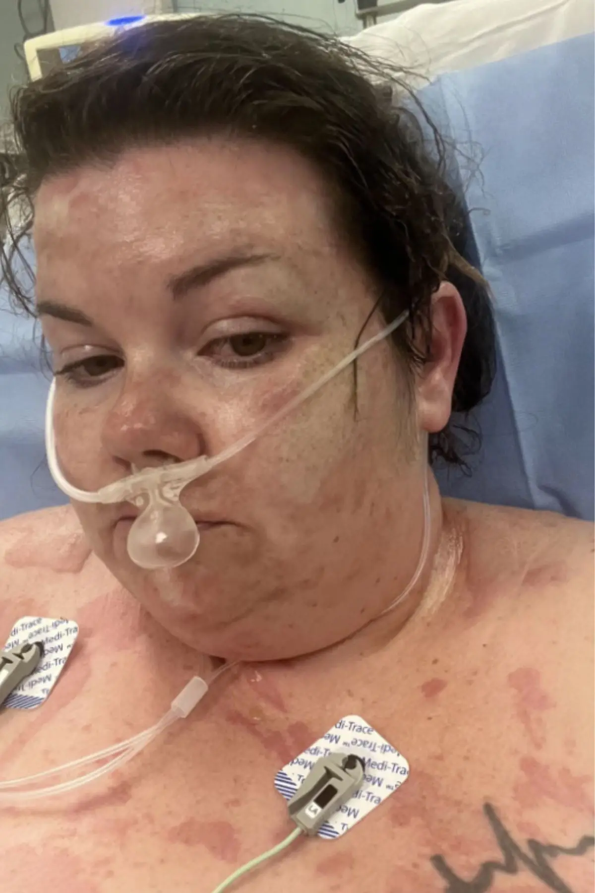 Sarita burnt 50 percent of her body. (True Life Stories)