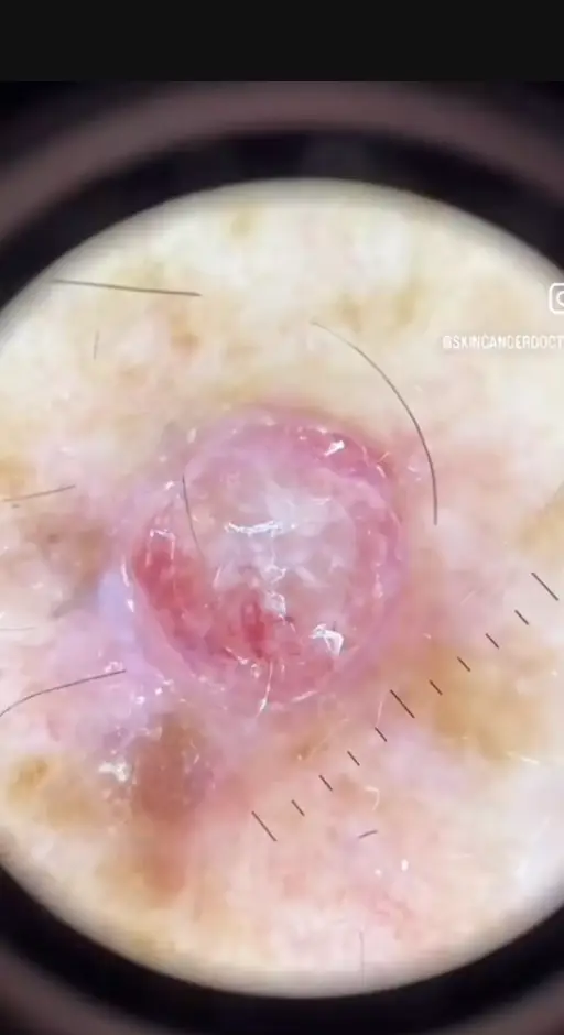 The form of cancer can be deadly (@skincancerdoctor/TikTok)