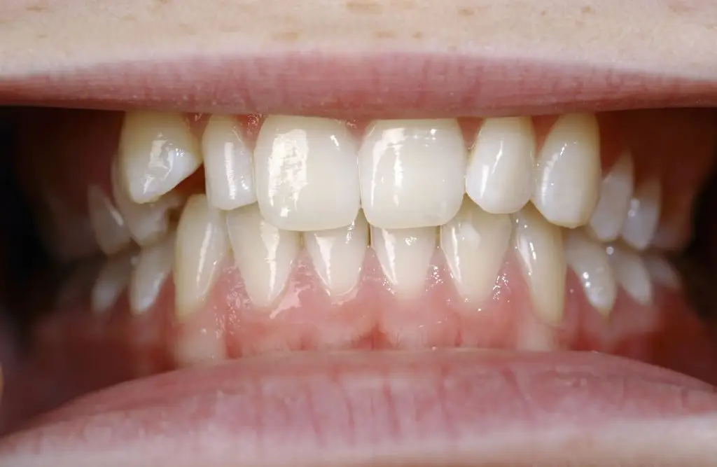 Teeth will look and feel healthier without caffeine (Universal Images Group via Getty Images)