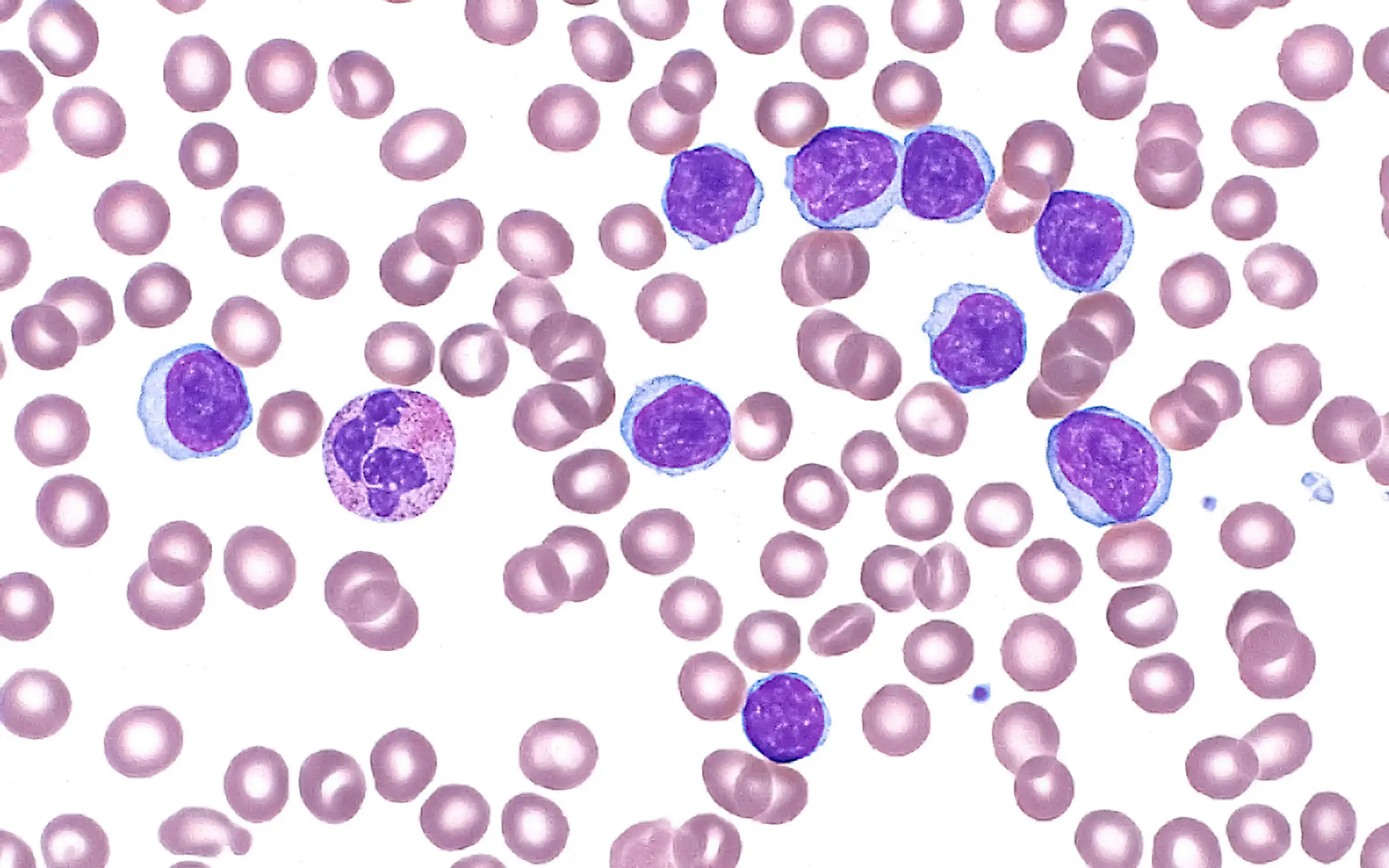 They found out she may have leukemia hours after she gave birth (ZIAD M. EL-ZAATARI/SCIENCE PHOTO LIBRARY)