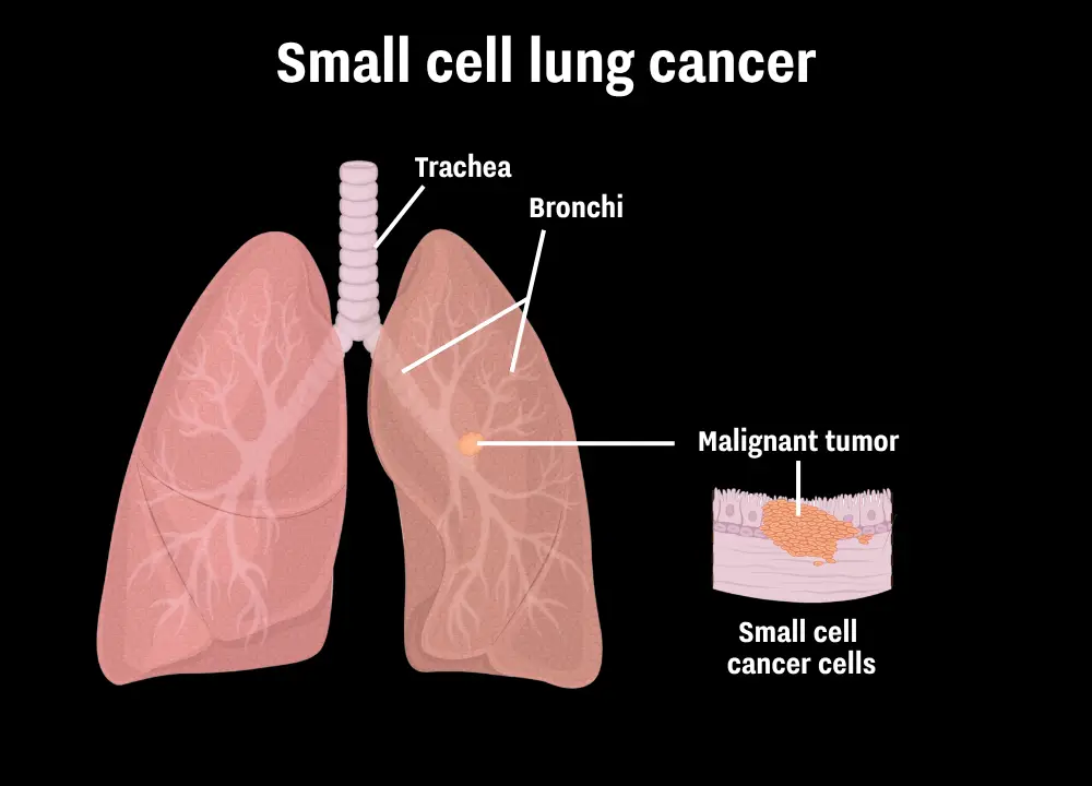 Small cell lung cancer is a rare, fast-growing lung cancer (UNILAD/Getty Stock Images)