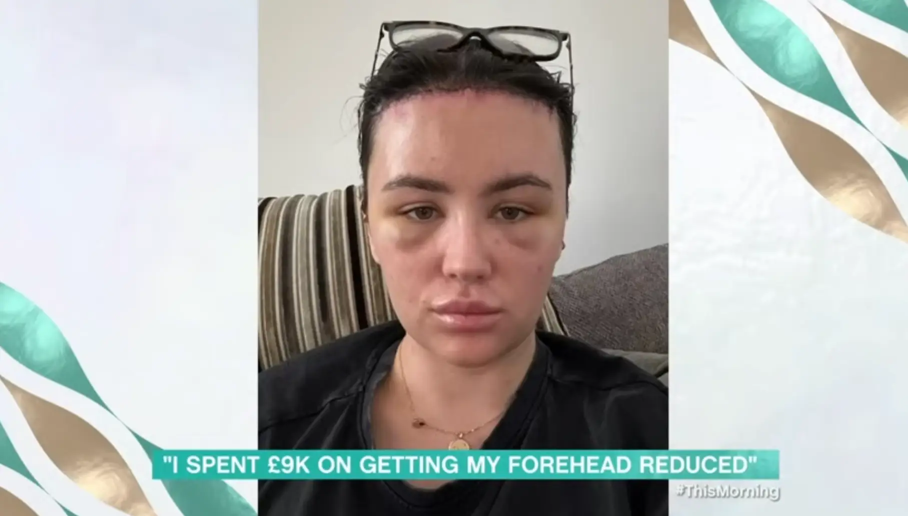 Beth was left with a lot of bruising and swelling after the surgery. (ITV)