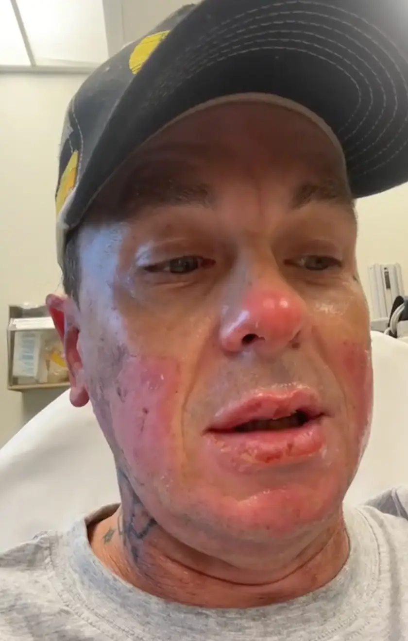 The Slipknot star said part of his face was 'melted' (@sidthe3rd/Instagram)