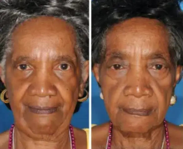 Doctors say it's often obvious when someone smokes (American Society of Plastic Surgeons)