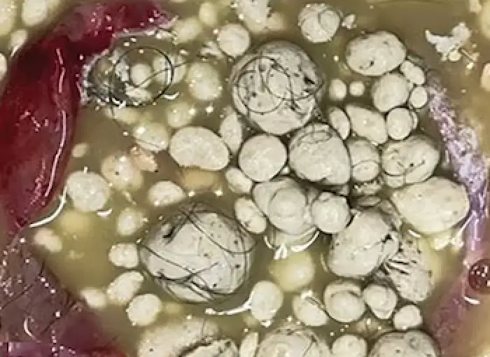 Doctor's described the tumor as a 'sack of marbles' (Radiology Journal)