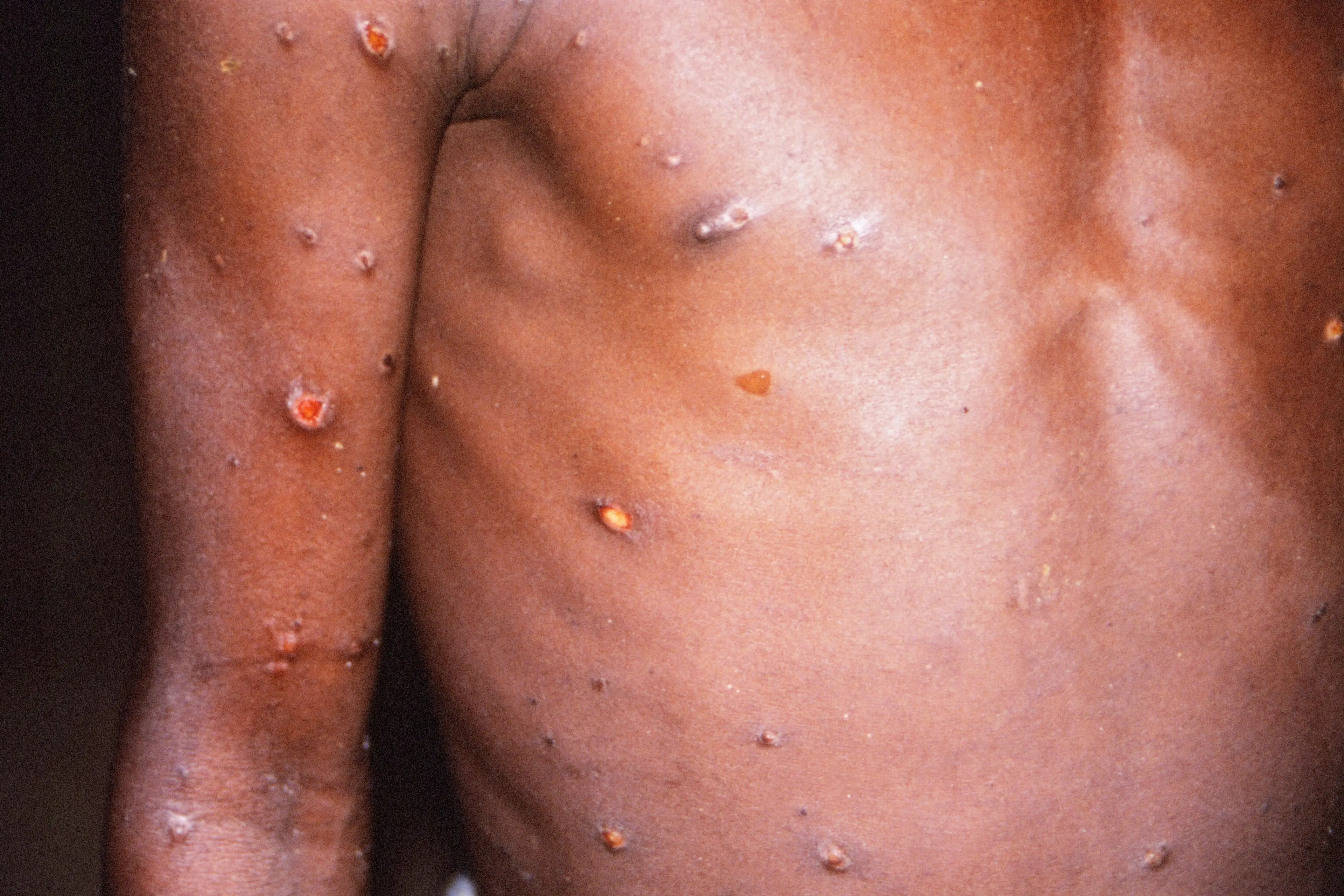 Monkeypox has been confirmed in the US.