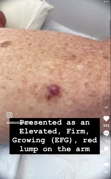 How it looked from the surface (@‌skincancerdoctor/TikTok)