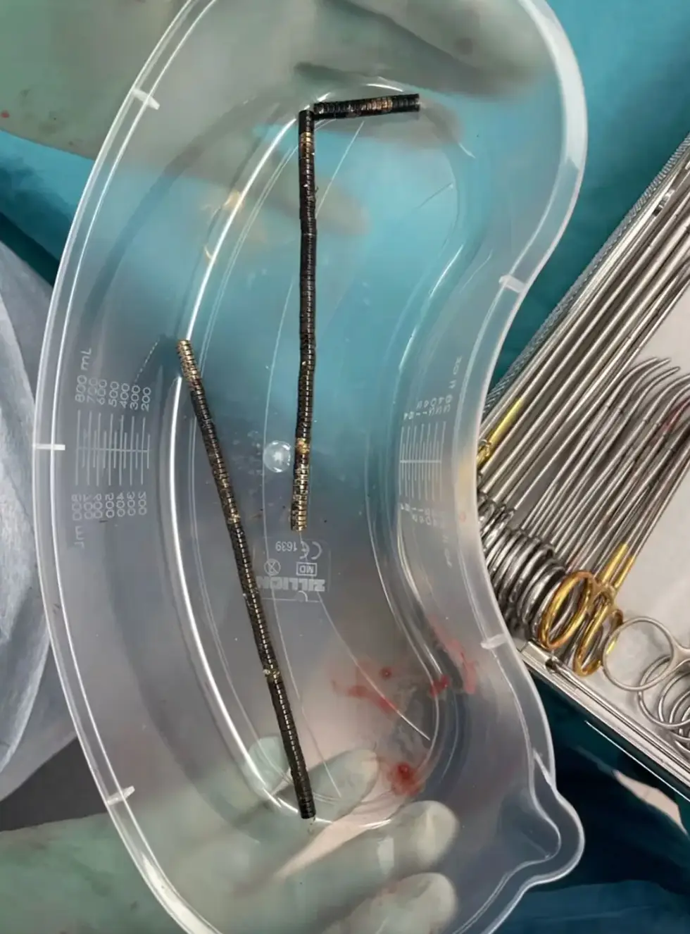 The high-power magnets had fused together inside his gut (New Zealand Medical Journal)