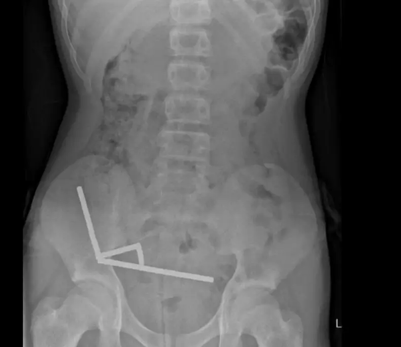 The boy had to have part of his bowel removed (New Zealand Medical Journal)