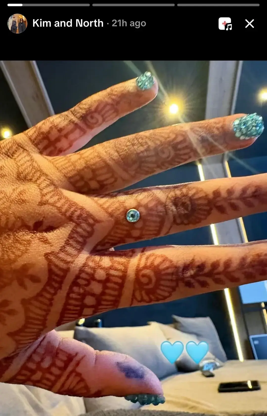 It appears that North West got two dermal piercings