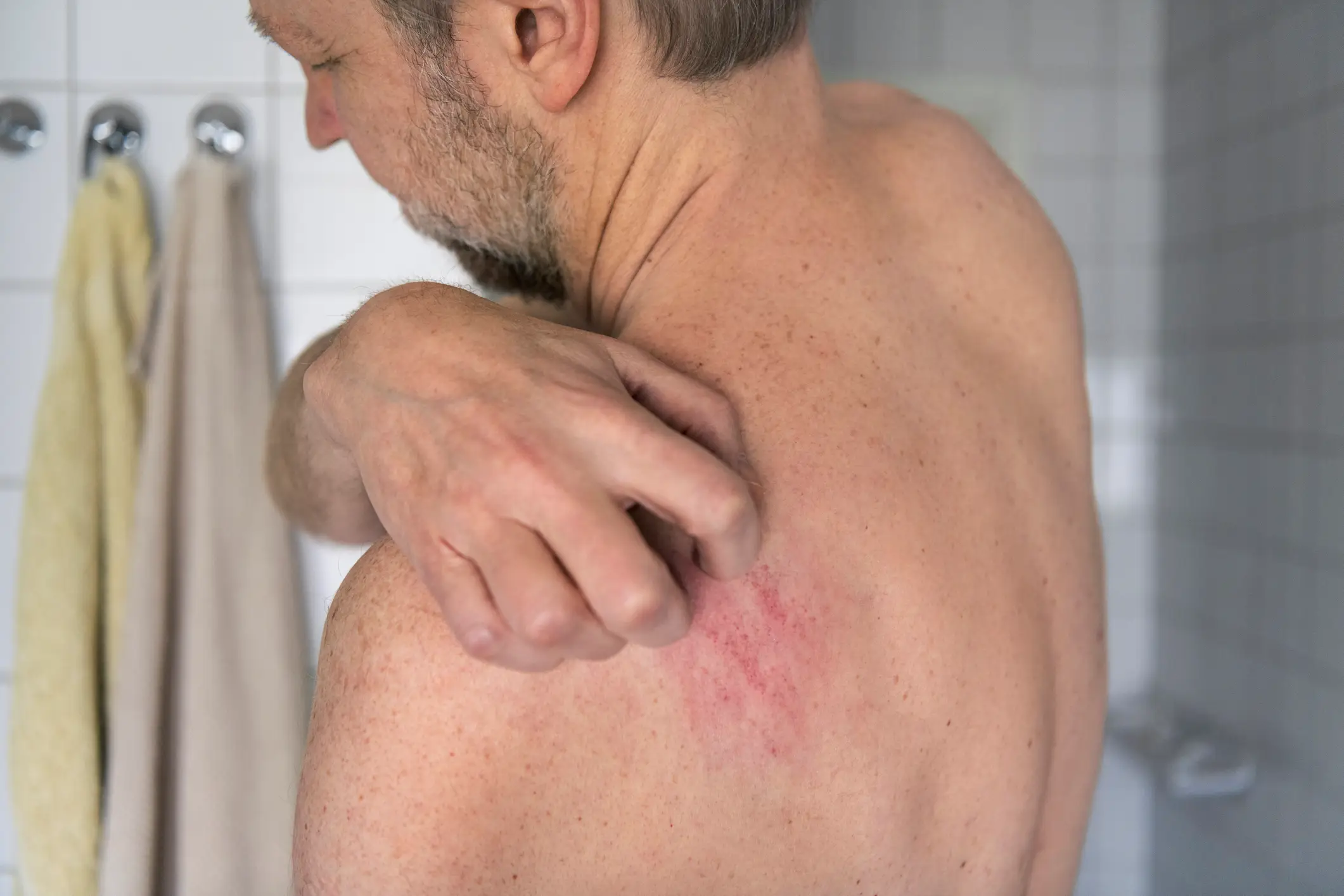 You're at risk of rashes and infections (Johner Images / Getty)