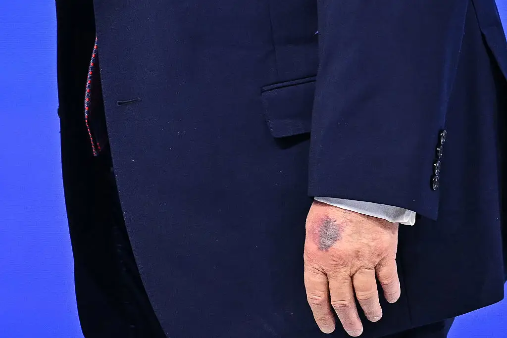 President Trump was seen with a large bruise on his hand yesterday (Fabrice COFFRINI / AFP via Getty Images)