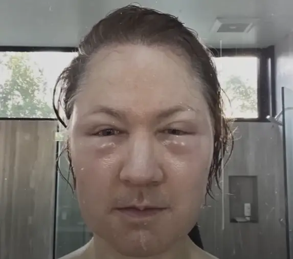 Fat injections led to an allergic reaction (YouTube/BryanJohnson)