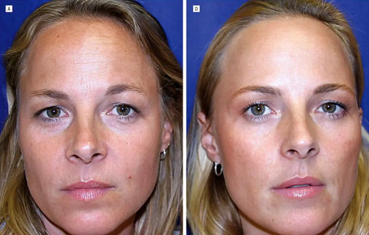 Twin 1 (left) had more noticeable wrinkles after 13 years with minimal Botox (American Society for Dermatologic Surgery)