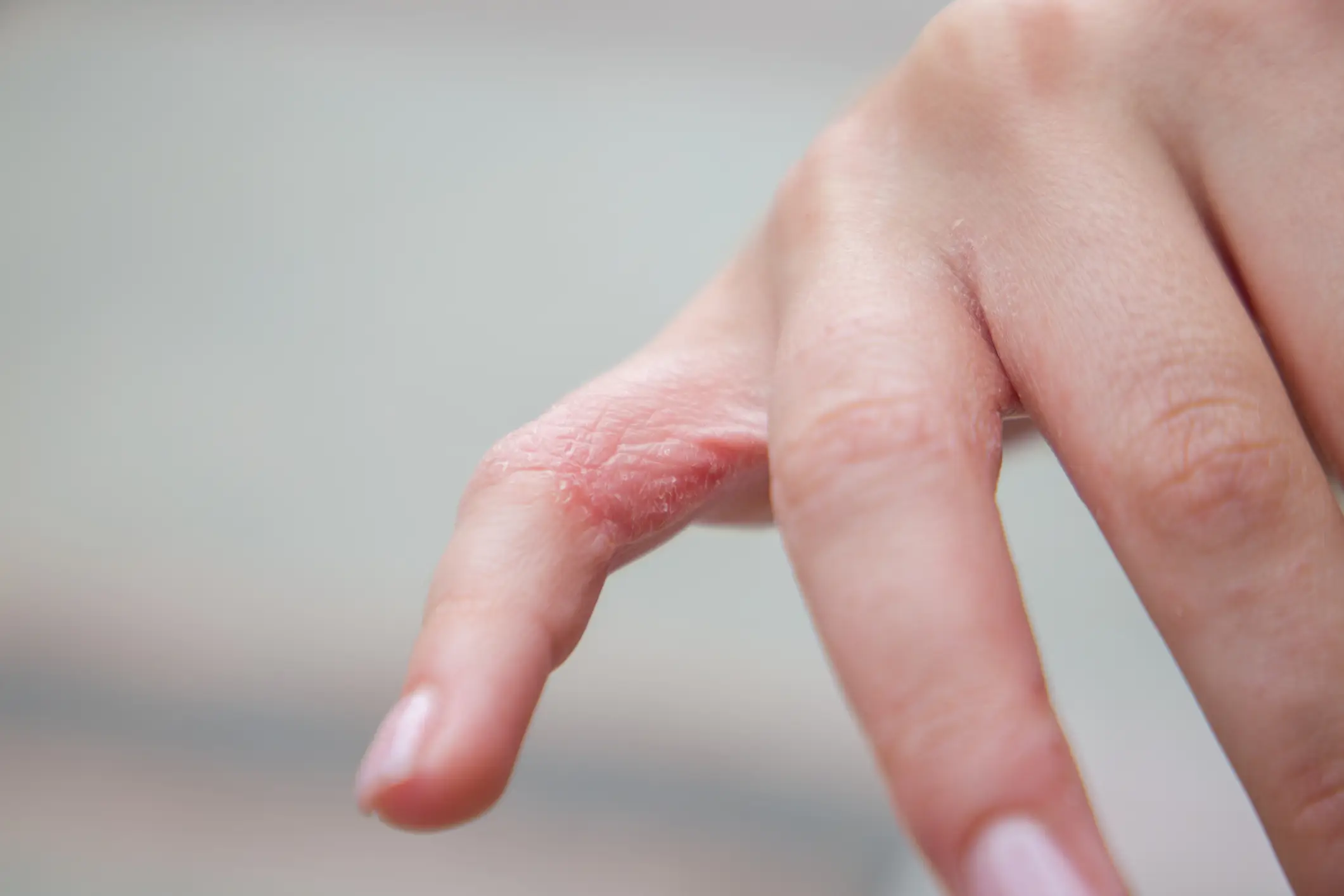 Doctors have said the condition could be caused by stress, excess heat and sweating, and/or sensitivity to metals like nickel, cobalt or chromate. (Getty stock image)