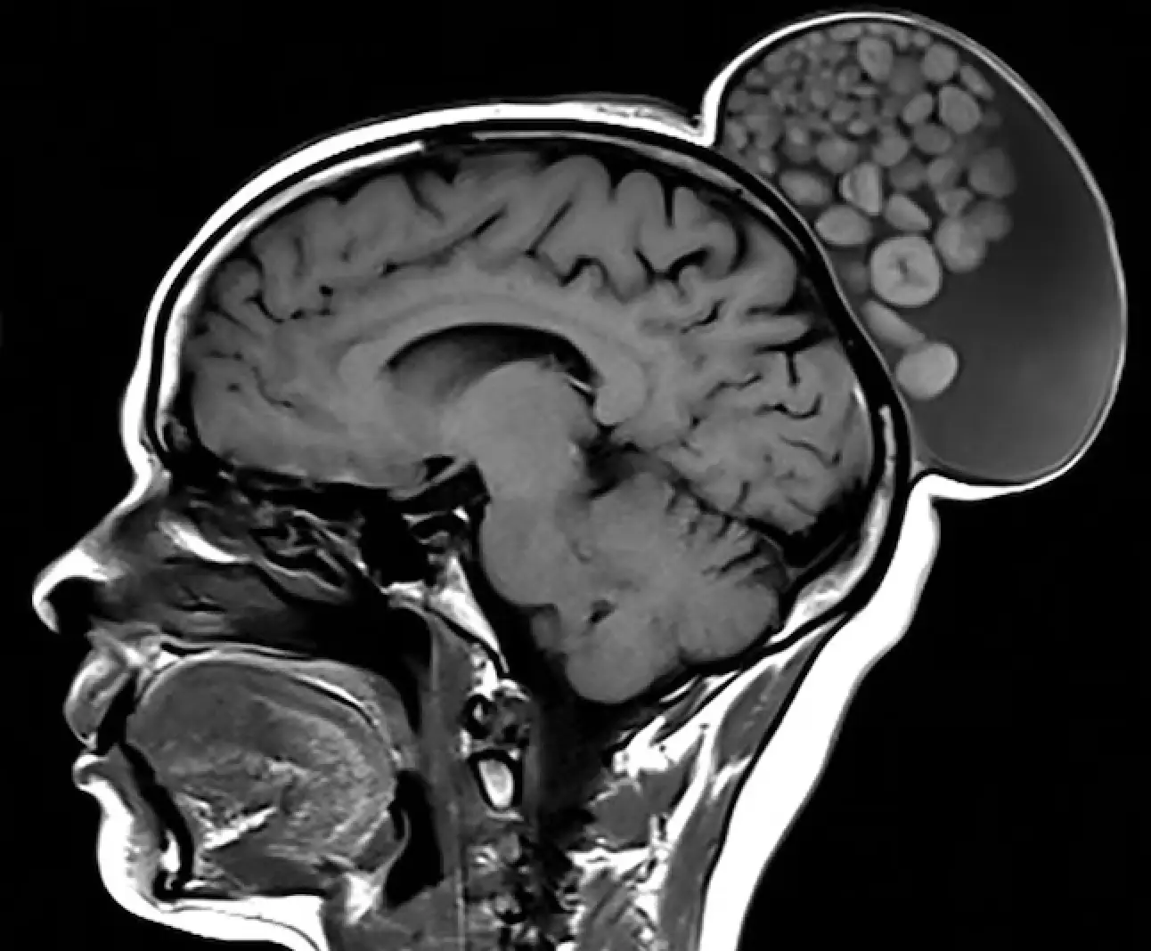 The 52-year-old woman had a cyst on the back of her head that was so large it was described as 'a sack of marbles' (Radiology Journal)