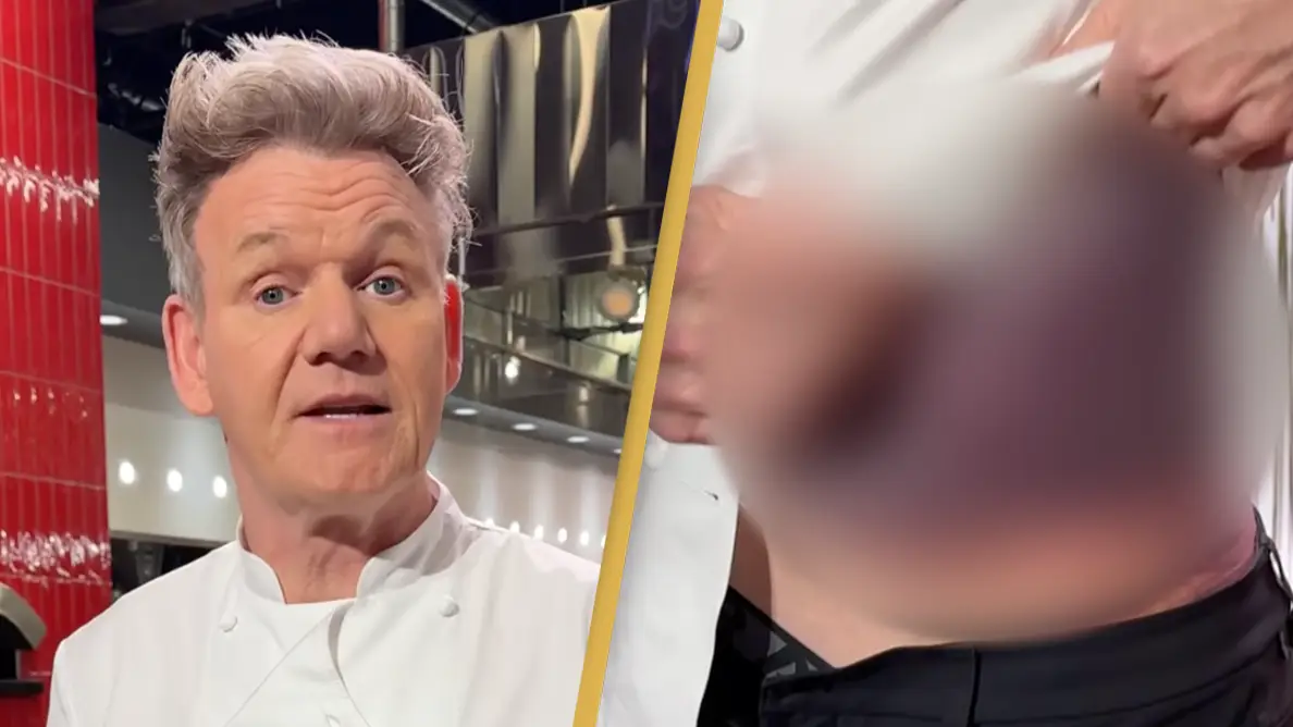 Gordon Ramsay shares 'very important message' as he reveals horrific injuries from bike accident