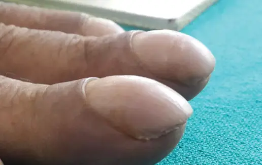 Clubbing can change the structure and appearance of your nails (Cleveland Clinic Journal of Medicine)