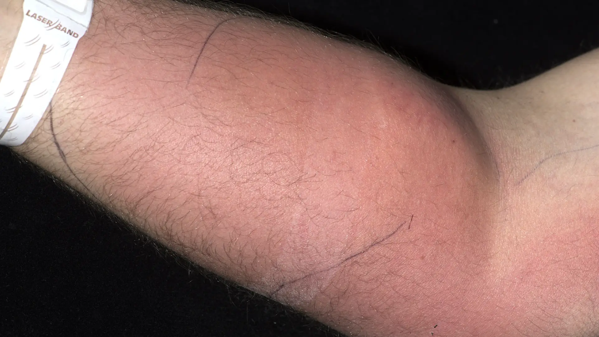 Man suffered horrifying side effects after injecting himself with own sperm to 'cure back pain'