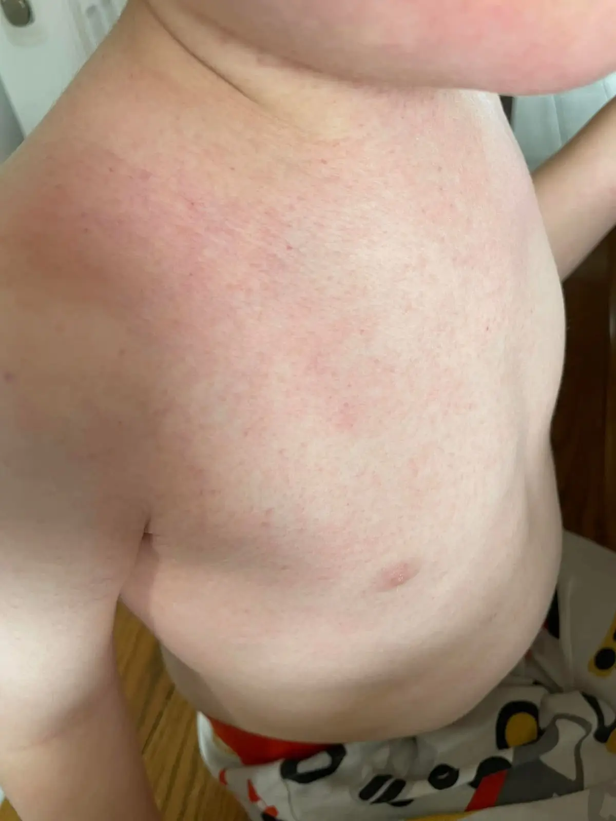It all started when Oscar developed a rash in 2022 (PA Real Life)